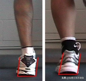 功能性扁平足对体态有什么影响,女生扁平足带来的体态改变