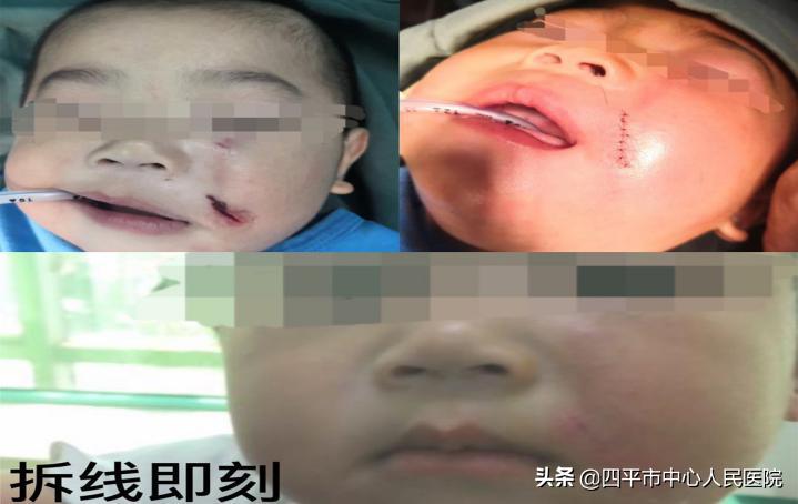 小儿的皮外伤怎么处理,小儿外伤缝合