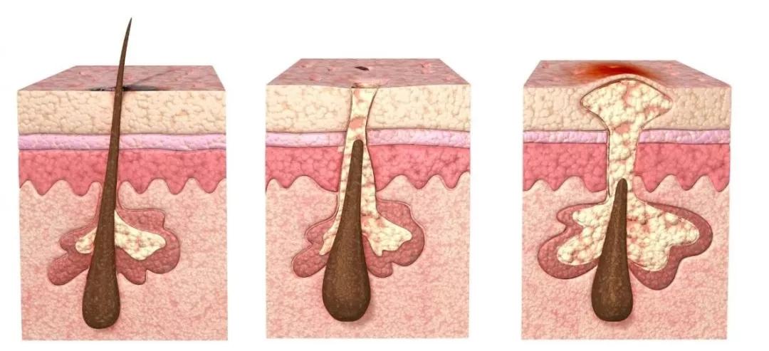 闭口毛孔粗大怎么去角质,闭口痘痘皮肤粗糙毛孔粗大