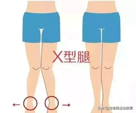 膝盖x型腿怎么矫正,x型腿导致膝盖疼吗