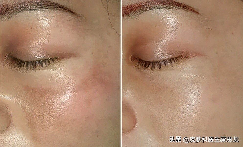 揭秘光子嫩肤的过程,一文看懂光学深度解读