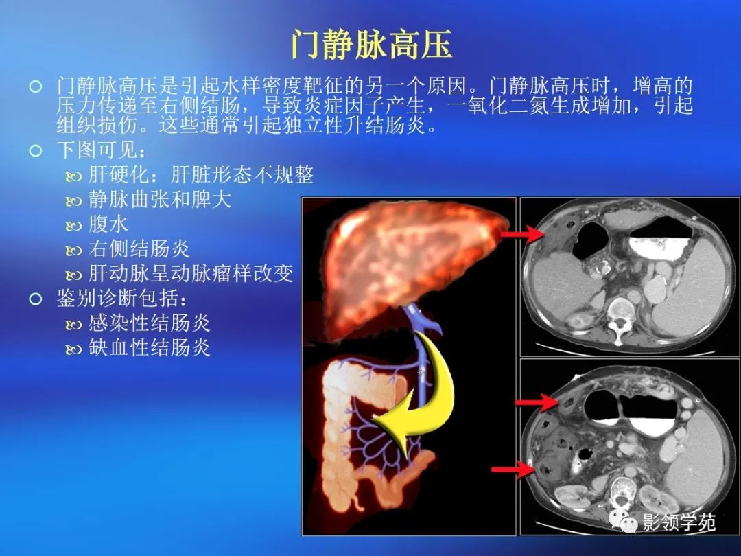 肠道内壁增厚,肠道扩张ct表现