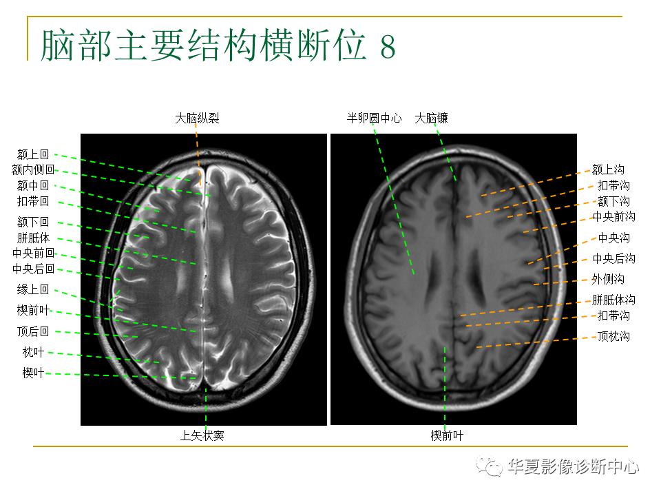 中国人脑立体定向mri应用解剖图谱,脑mri示意图