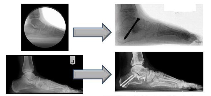扁平足痛是什么感觉,扁平足是很严重的问题吗
