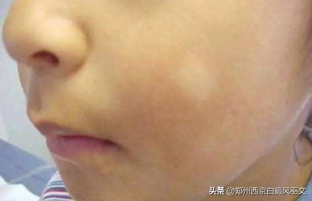 7岁儿童白癜风自愈案例,7岁儿童白癜风治愈经历