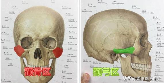 颧弓内推术颧骨磨骨,颧骨颧弓磨骨手术全过程