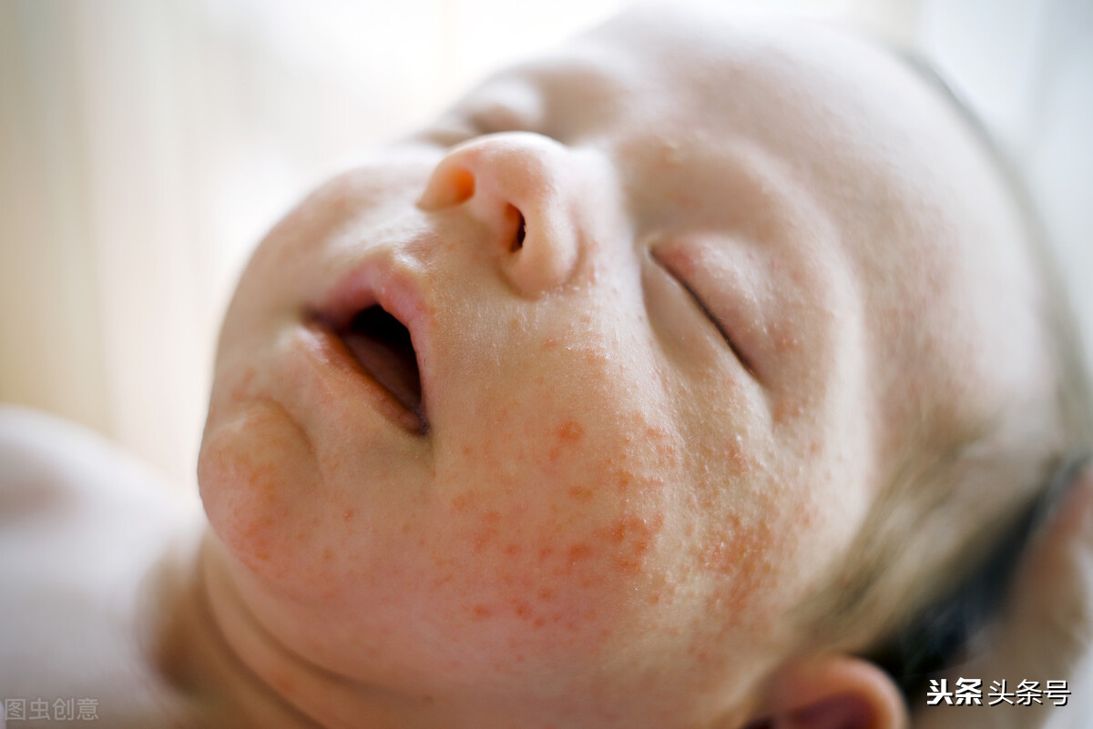 宝宝湿疹反复发作如何治疗,宝宝湿疹反复发作一招解决