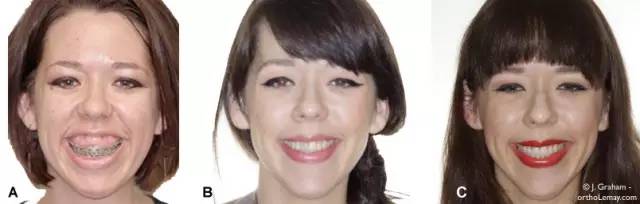 笑露牙龈怎么整,笑露牙龈怎么矫正训练