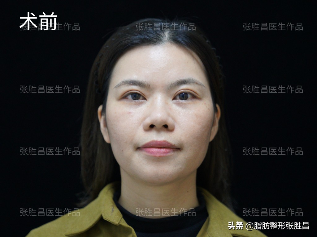 34岁广东女生，颧骨突出显刻薄苦相，脂肪填充后美成人间富贵花