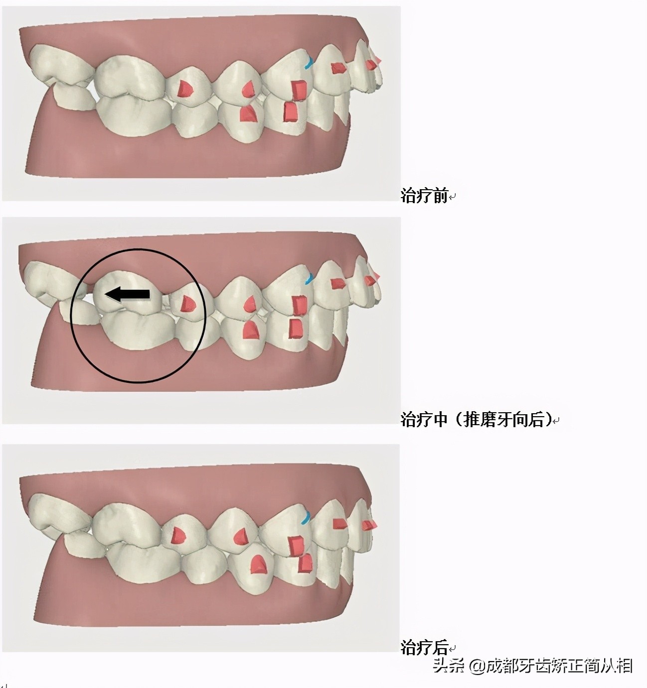 牙齿拥挤怎么矫正最快,下牙牙齿拥挤怎么矫正