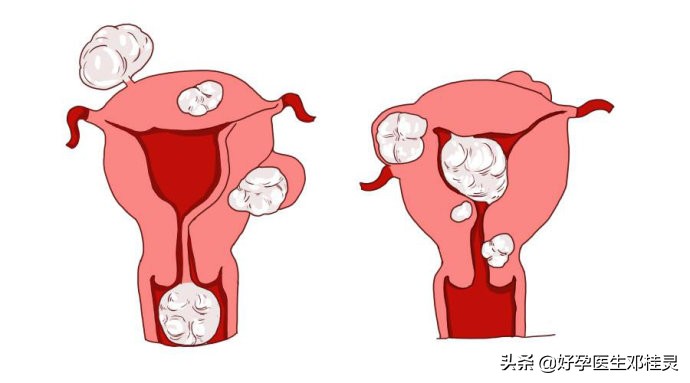 我怀不上二胎都是你们取环取的！医生们都懵了：取环会影响怀孕？