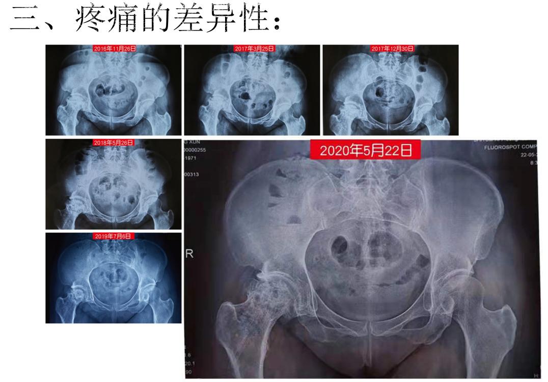 对股骨头缺血性坏死疼痛的治疗体会