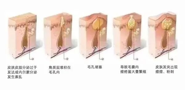 痘痘好了之后痘印怎么去除,痘痘留下的痘印痘坑怎么修复