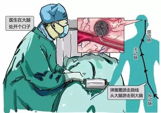 惊心动魄的心血管介入手术,脑动脉瘤开颅的全过程实例