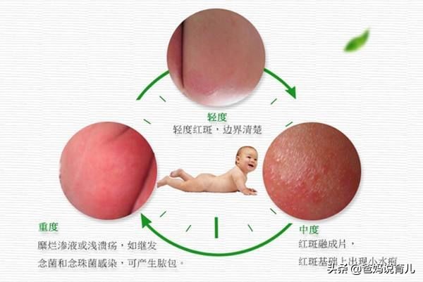 宝宝红屁股反复抹什么药,宝宝红屁股反反复复该怎么办
