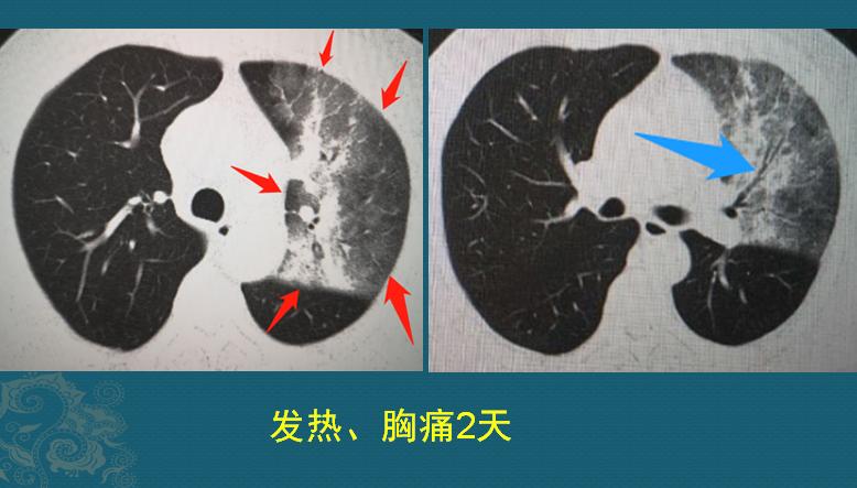 小伙肺炎治愈,小伙肺炎住院第一天