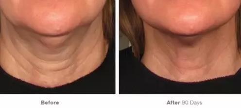 超声刀战胜法令纹原理,超声波祛法令纹有用吗