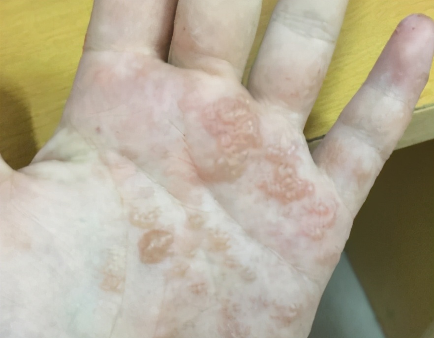 常见的手部皮肤病干燥脱皮爆裂,手部脱皮严重是什么样的