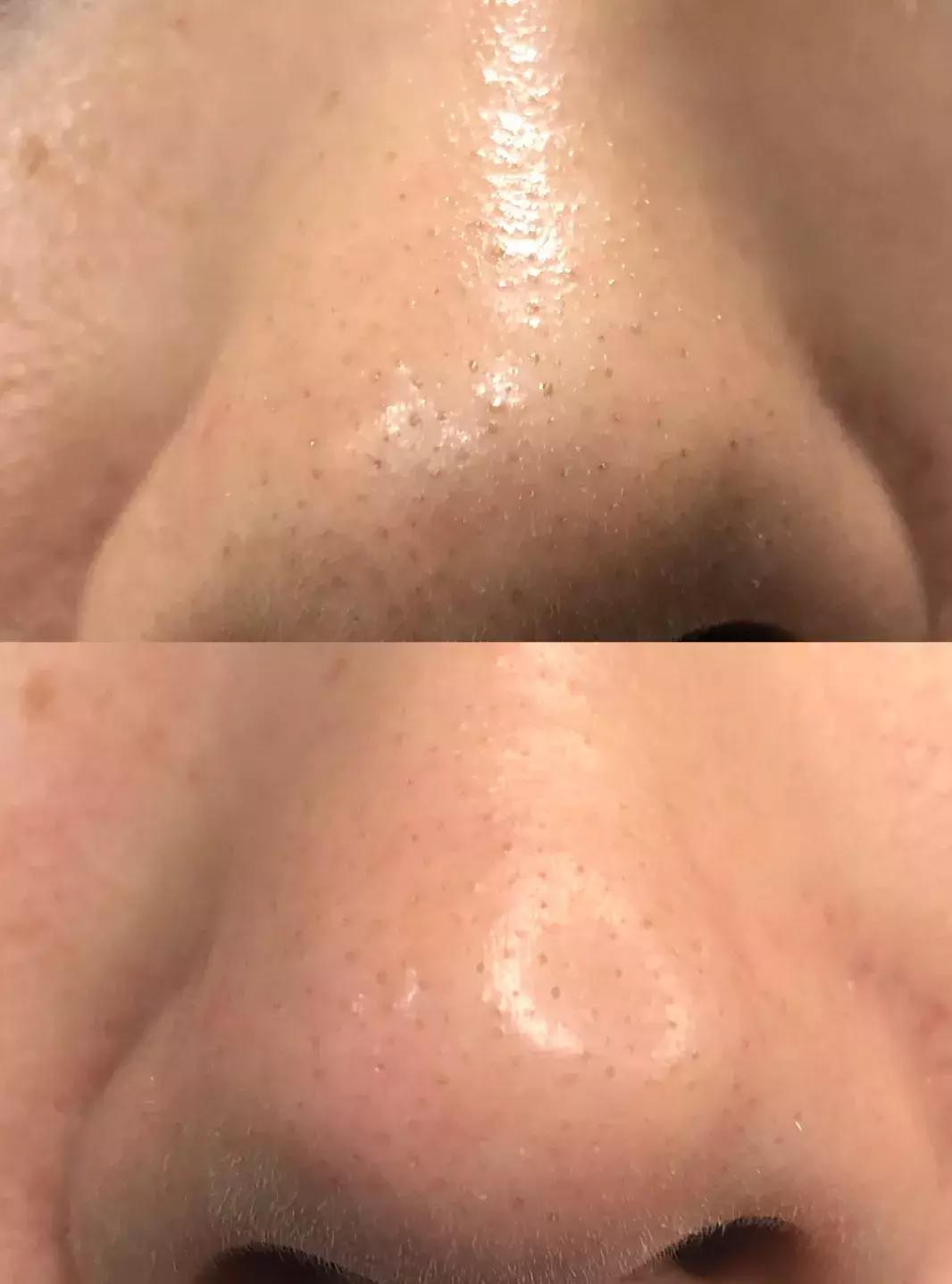 洗脸清洗黑头,洗脸清洁去粉刺