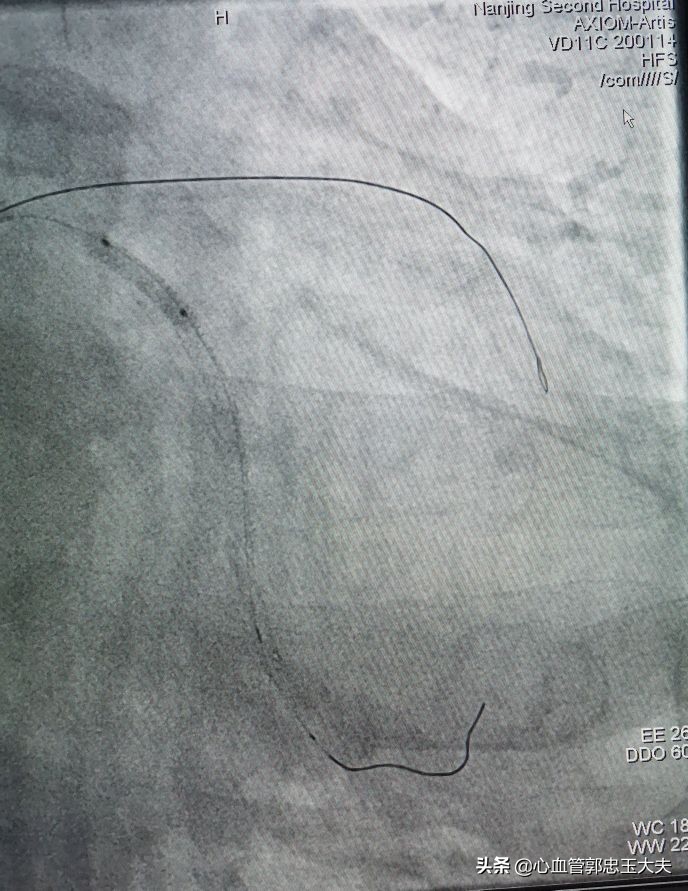 CTO遇到钙化病变怎样才能把血管打通？