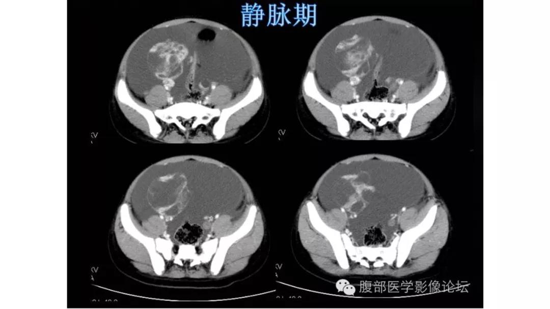 卵巢原发肿瘤的分析思路