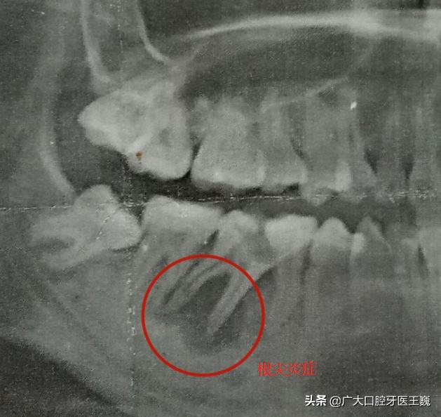 牙痛是一种难以忍受的折磨,牙痛备受折磨