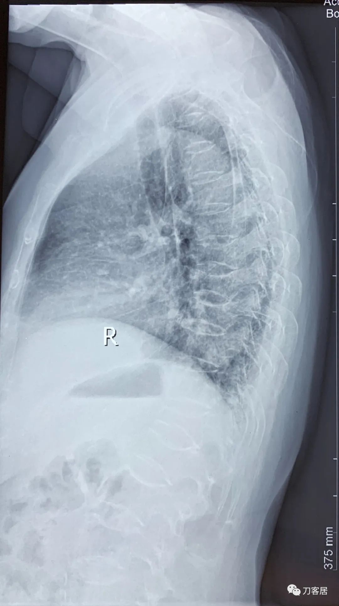 胸椎压缩性骨折病历,脊柱骨质疏松性压缩性骨折