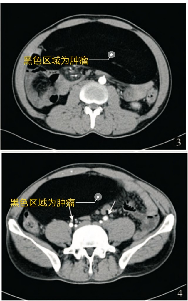 开腹腔切除肿瘤有危险吗 (腹腔内肿瘤割了又长)