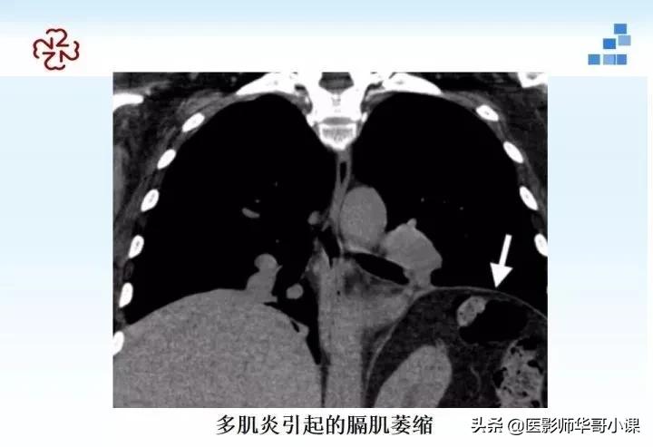 「精品课件」胸部膈肌的解剖及常见病变影像的表现