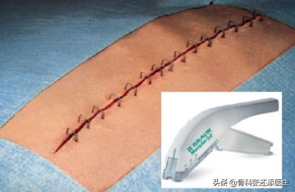 拉链缝合，可吸收止血海绵，这些医疗新科技，你有必要了解