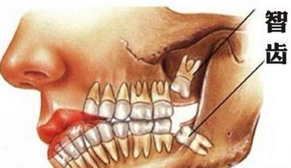 记录第一次拔牙全过程,一次性拔四颗智齿后的真实感受