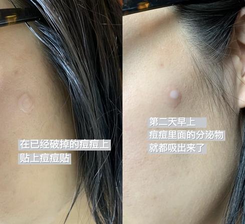 片仔癀淡化痘印凝胶,片仔癀祛痘痘贴有用吗