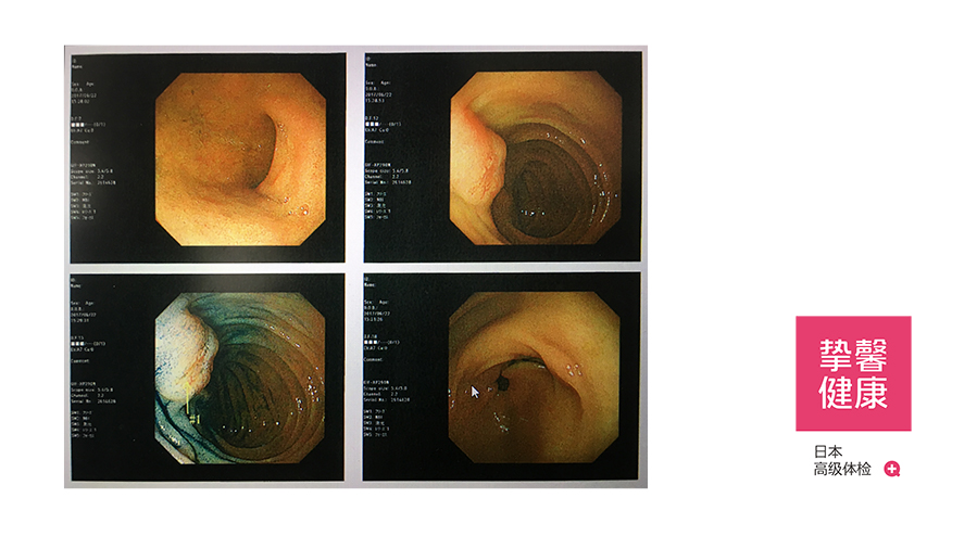 在日本做胃镜要预约吗,日本胃镜检查真实感受
