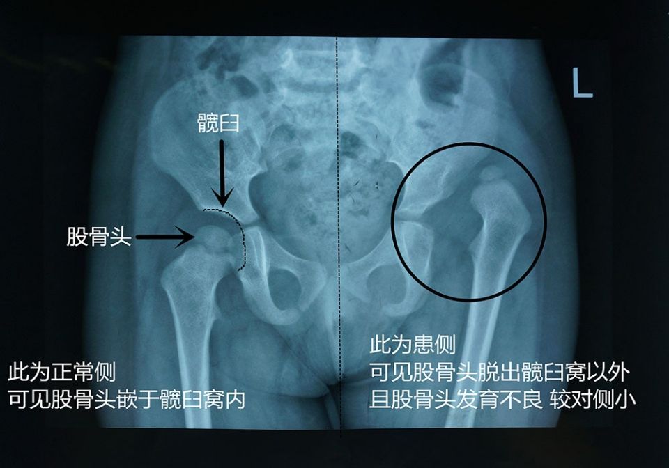 宝宝皮纹不对称腿好像粗细不一样,婴儿皮纹不对称多大治疗效果最好