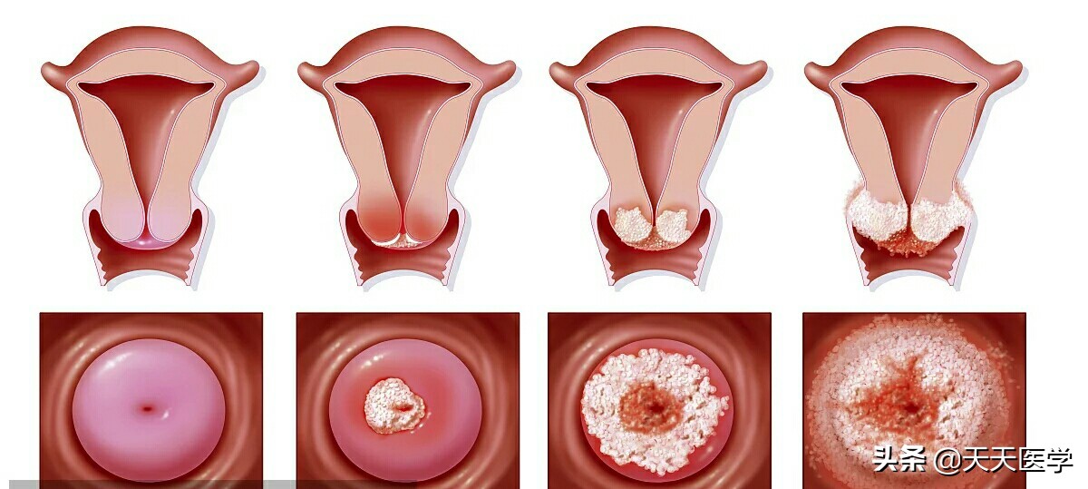 宫颈癌与hpv病毒,宫颈癌与疣