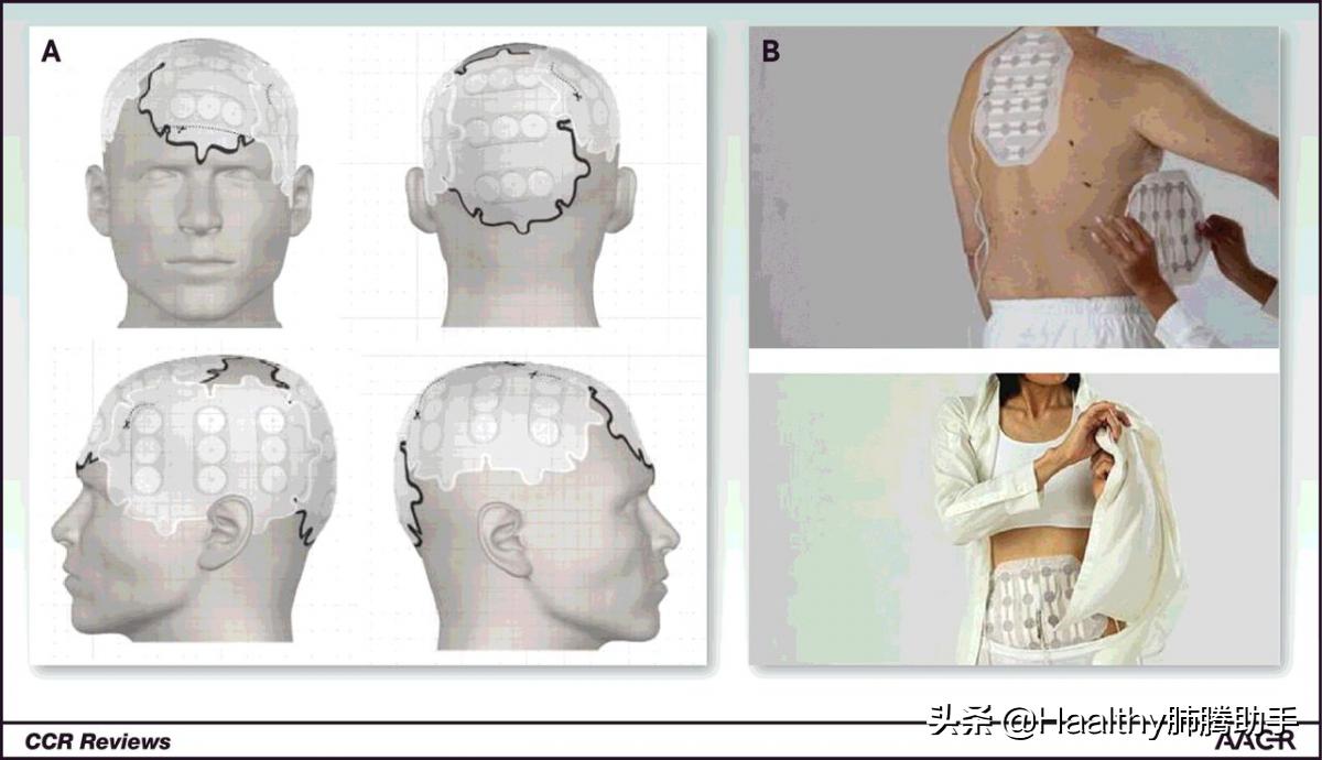 肺癌电场疗法,肿瘤治疗仪最新