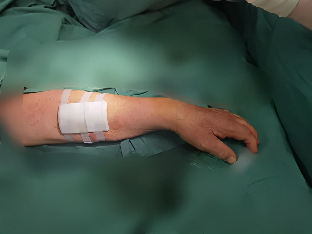 【医疗案例】内分泌肾内科独立成功开展首例自体动静脉内瘘成形术