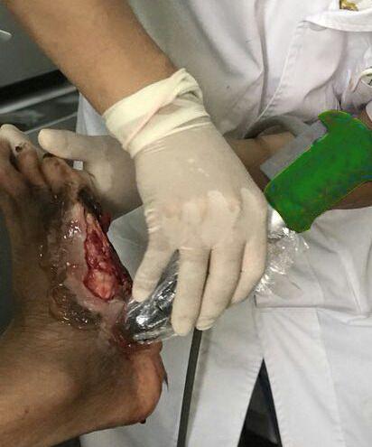 冲击疗法详细介绍,冲击疗法属于什么疗法