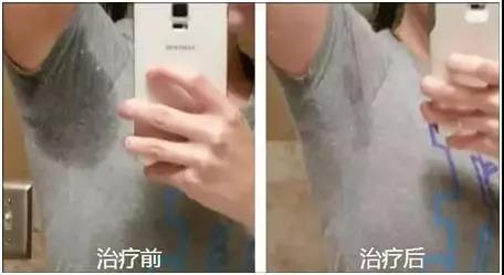 清新微波治疗腋臭一次的价格,清新微波治狐臭