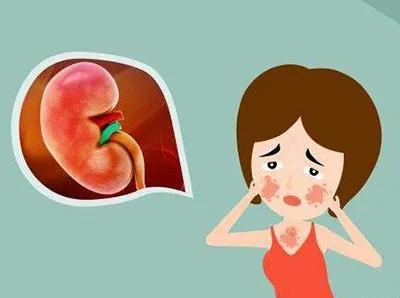 系统性红斑狼疮应该挂哪个科室,系统性红斑狼疮什么科室