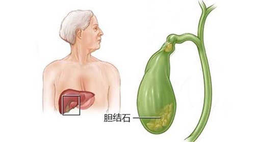 肝胆结石发病急救方法,结石发作真的要命