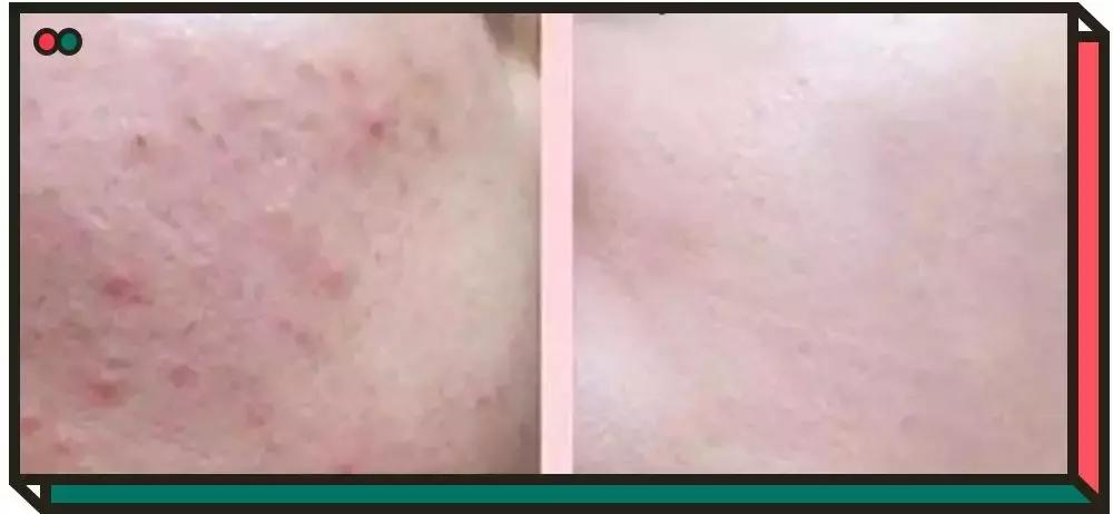 镇定舒缓消炎的护肤品,消炎镇静舒缓祛痘的水乳