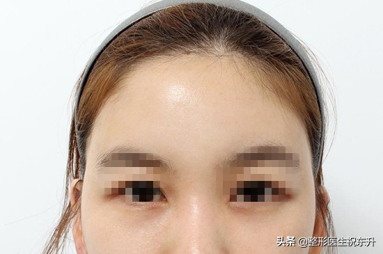 做眼袋去掉脂肪眼袋更松弛了,做眼袋眶隔释放怎么还有泪沟