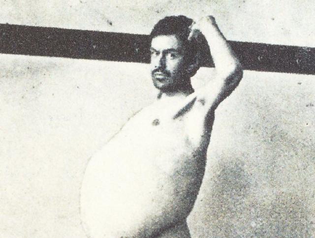 便秘严重拉不出能继续吃饭吗,便秘严重三四天不大便怎么办