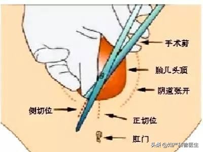 顺产10个侧切九个撕裂,十个顺产九个疼是真的吗