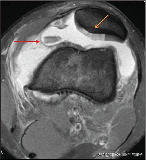 膝盖磕到了没肿但痛,膝盖磕了一下髌腱损伤怎么治