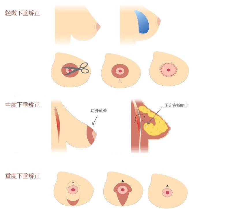 关于胸部是否下垂知识,关于胸部下垂
