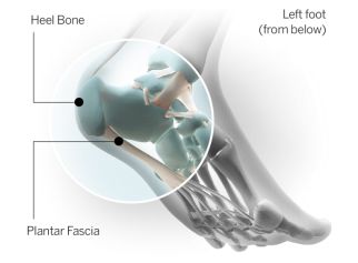 跑步足底痛的防治,足底跑步疼是什么症状
