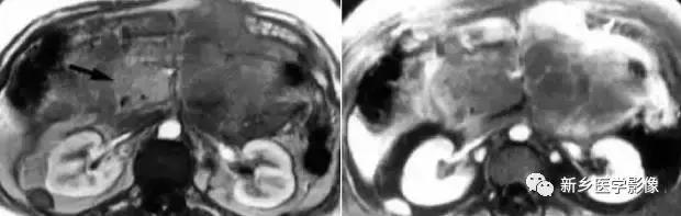 18种胰腺肿瘤，为什么我就知道两种
