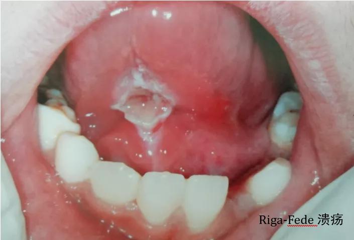 7岁宝宝嘴唇溃疡一大片，原因竟然是这个！#雅悦齿科#